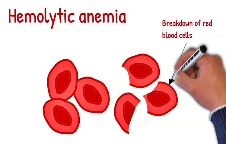 ما هو فقر الدم الانحلالي؟ الأسباب والأعراض والعلاج