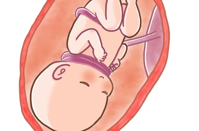 التفاف الحبل السري حول رقبة الجنين التفاف الحبل السري حول رقبة الجنين