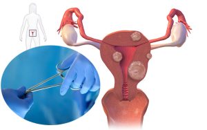 متى تكون الجراحة ضرورية للأورام الليفية الرحمية؟