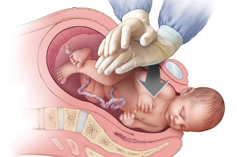 مشكلة عسر ولادة الكتف