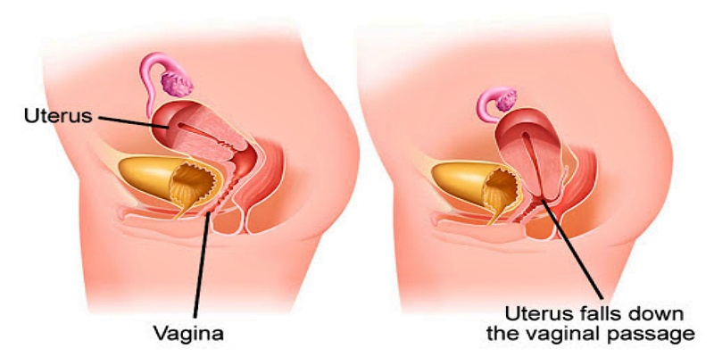 ما هو هبوط الرحم؟