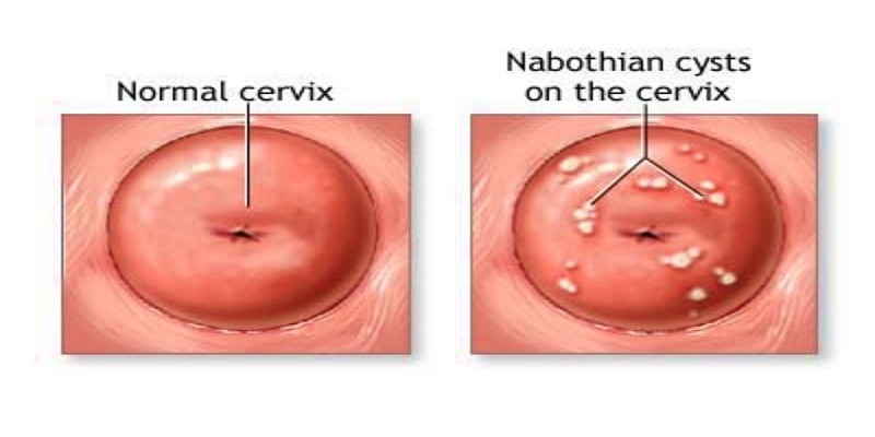 ما هو كيس نابوثيان المتواجد في عنق الرحم؟