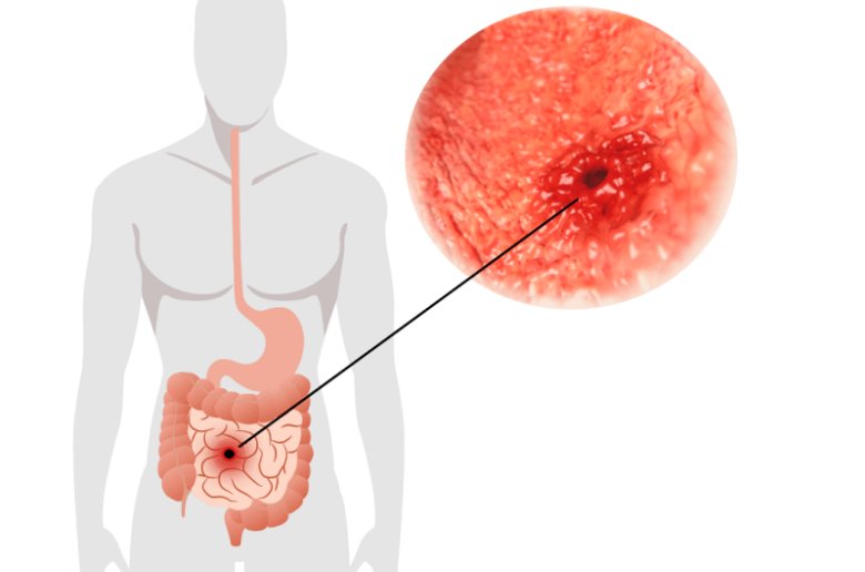 كيف تحدث الإصابة بثقب المعدة؟ وما مدى خطورة هذا الأمر؟
