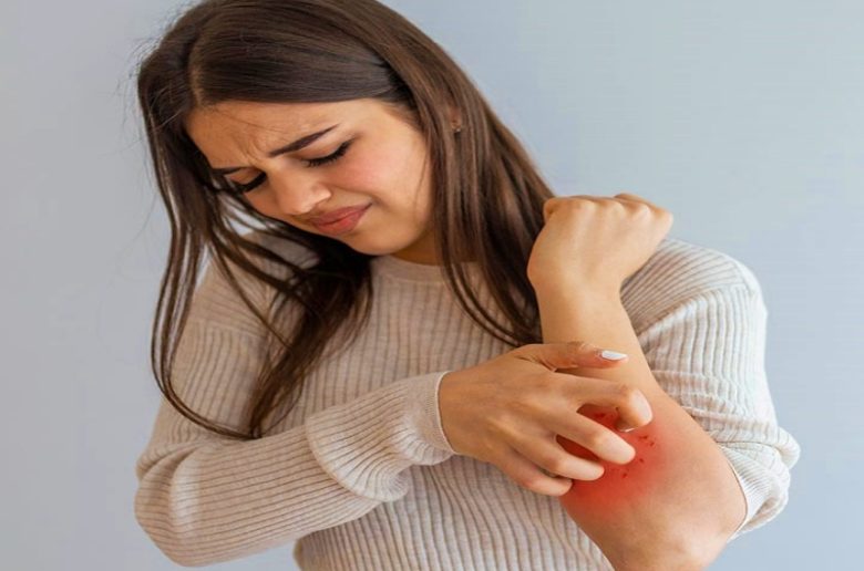 طفح الحمى الفيروسية وكيف نستطيع التخفيف من حدته؟