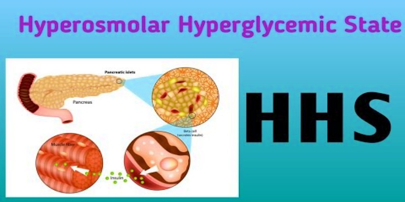 حالة فرط سكر الدم  (HHS)