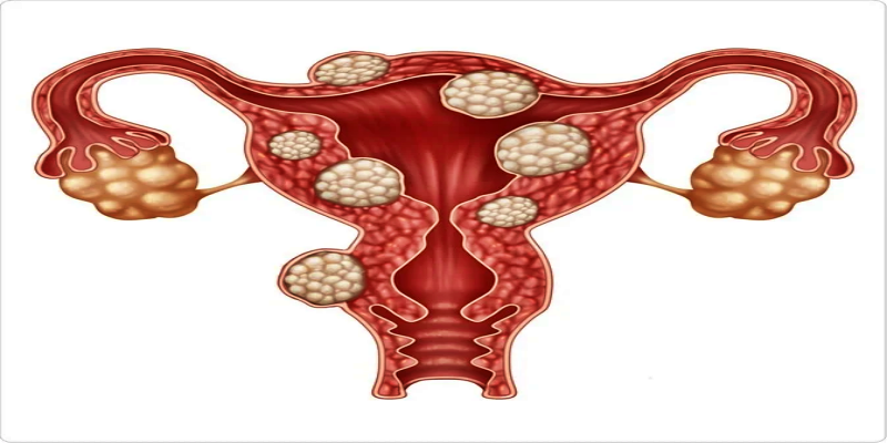 ما هي الأورام الرحمية الحميدة؟