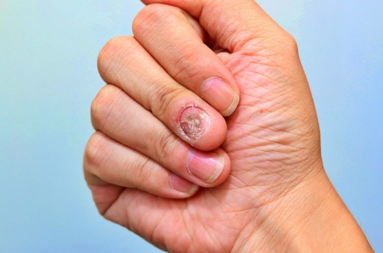 ضمور الأظافر.. الأعراض والأسباب وطرق العلاج