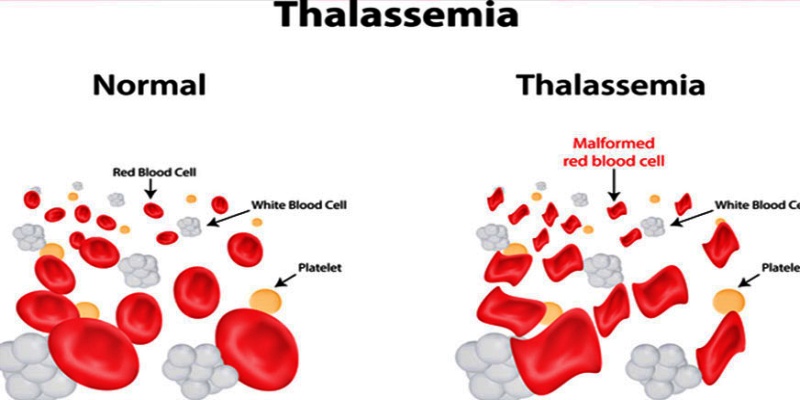 ما هو مرض الثلاسيميا؟