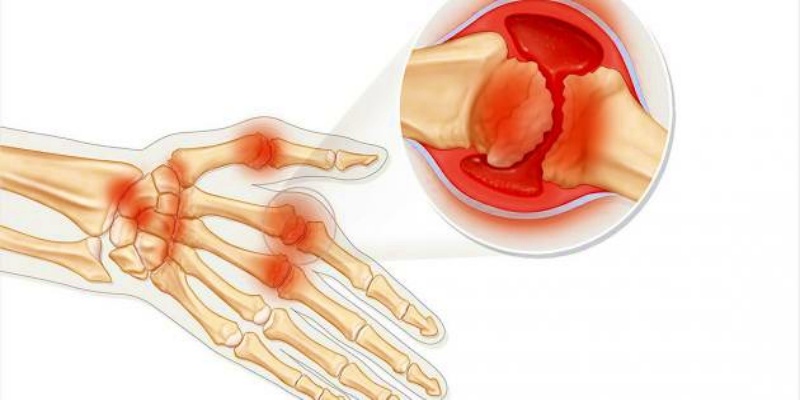 التهاب المفاصل الروماتويدي