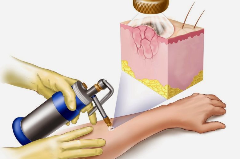 العلاج بالتبريد