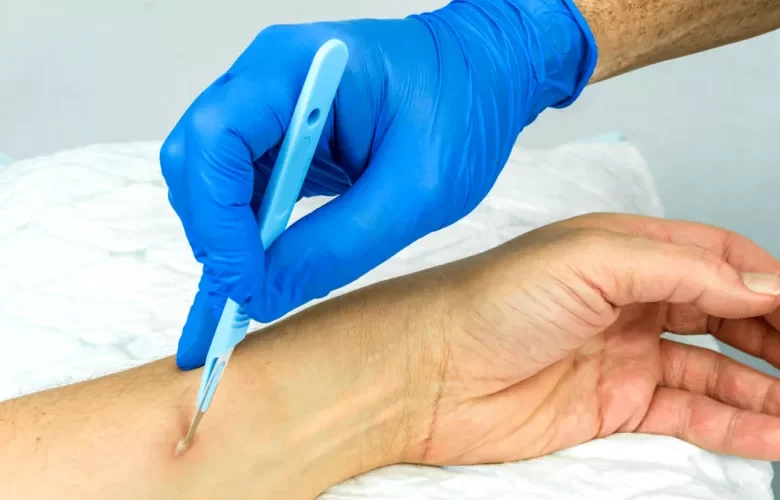 جراحة تصريف الخراج