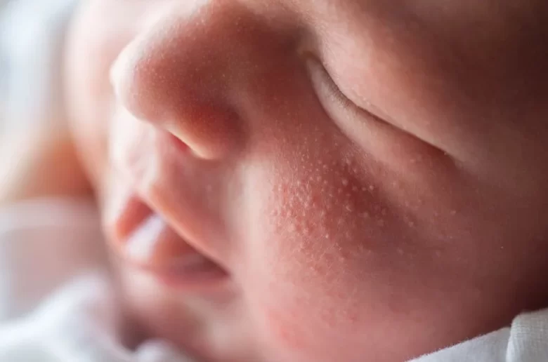 حب الشباب الدخني