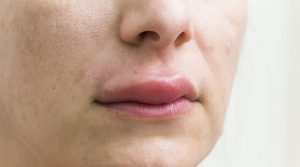 حساسية الكيوي ذات الصلة بمتلازمة حساسية الفم