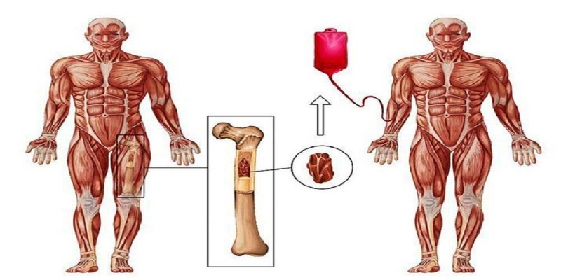 زراعة النقي المُتطابق