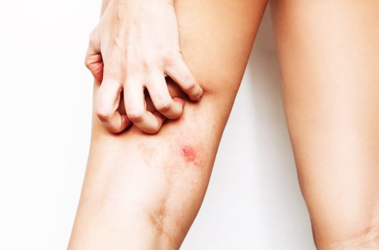 سعفة الفخذين سعفة الفخذين