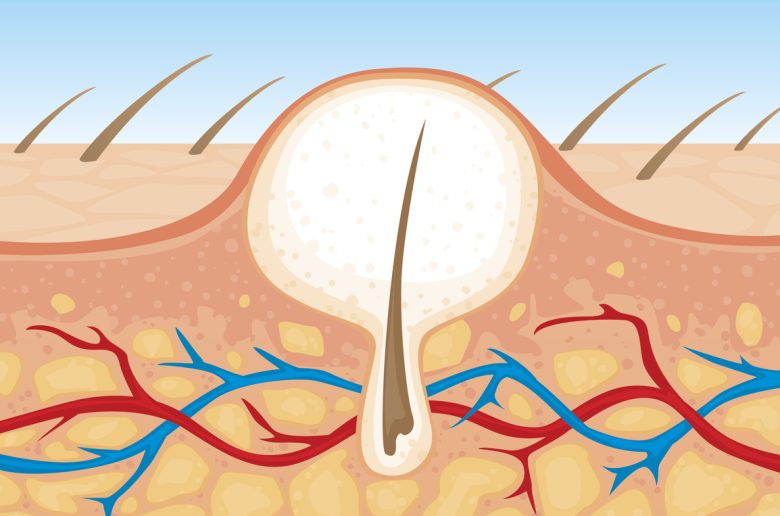 ظاهرة نمو الشعر تحت الجلد