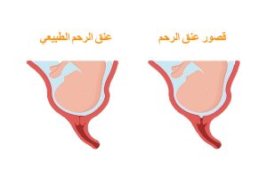 قصور عنق الرحم