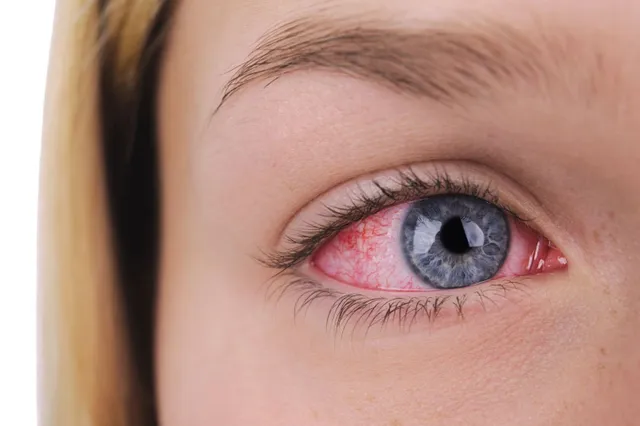 ما هي متلازمة سجوجرن؟