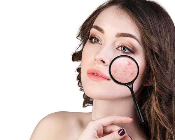 مكياج للبشرة المعرضة لحب الشباب مكياج للبشرة المعرضة لحب الشباب