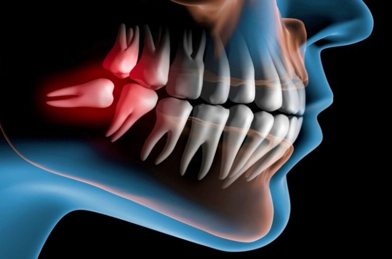 ضروس العقل.. متى تنمو؟ وما هي علامات ظهورها؟