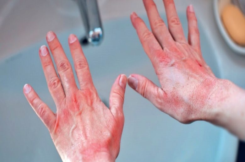 حساسية الصابون.. أسباب حدوثها وكيف يتم علاجها؟