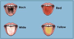 لون اللسان غير الصحي