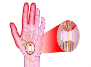متلازمة النفق الرسغي