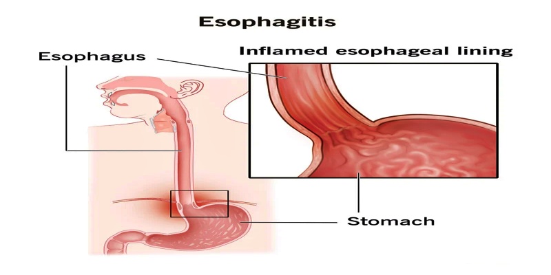ما هو مرض التهاب المريء؟