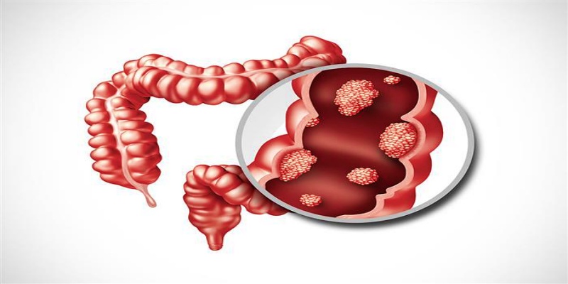 فحص سرطان القولون والمستقيم