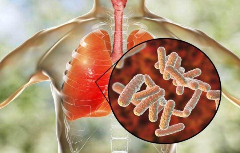 عدوى الكلبسيلا الرئوية وأهم الأمراض المسببة لها