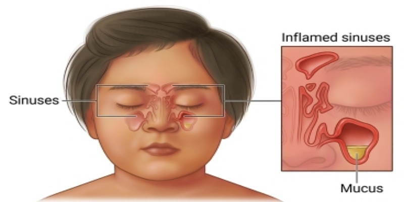 ما هي أسباب إصابة الأطفال بالتهابات الجيوب الأنفية؟