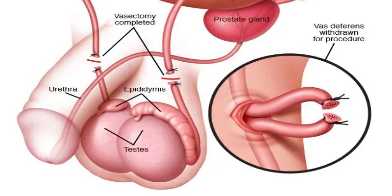 ما المقصود بقطع القناة المنوية؟