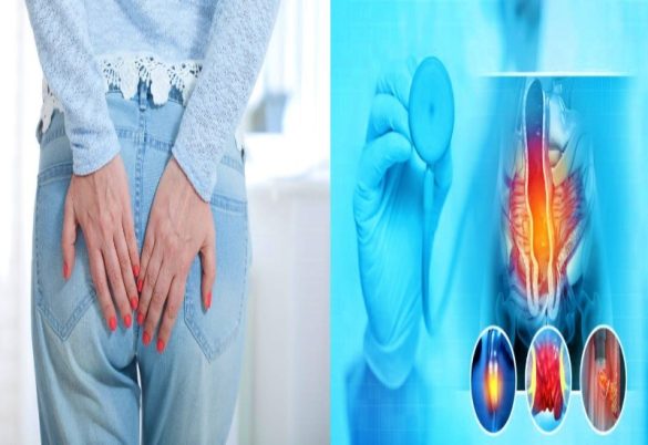 أهم 3 مضاعفات لمرض البواسير يجب ألا يتم تجاهلها أهم 3 مضاعفات لمرض البواسير يجب ألا يتم تجاهلها