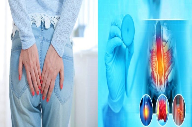 أهم 3 مضاعفات لمرض البواسير يجب ألا يتم تجاهلها