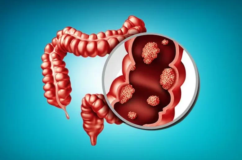 سلائل القولون.. أورام حميدة بمضاعفات صحية خطيرة