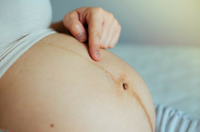 الخط الأسود أثناء الحمل