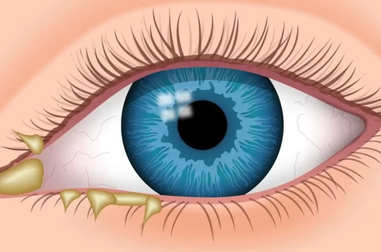 دليك لإفرازات العيون