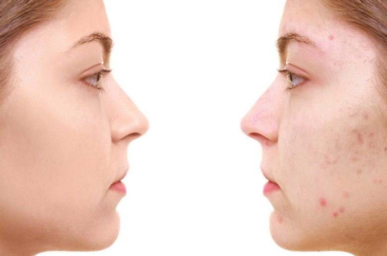 5 طرق طبية فعالة لعلاج ندبات وحفر البشرة 5 طرق طبية فعالة لعلاج ندبات وحفر البشرة