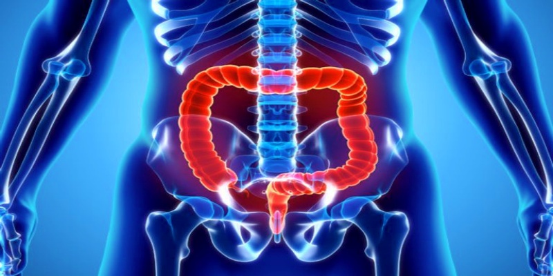 اضطرابات الأمعاء والمستقيم
