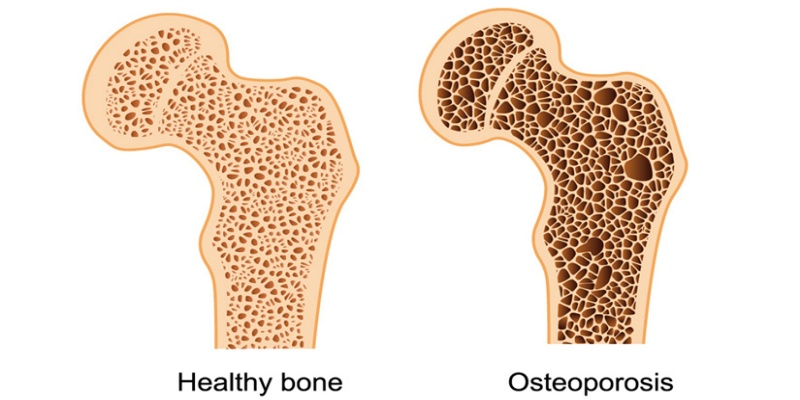 هشاشة العظام المرض الصامت الخطير