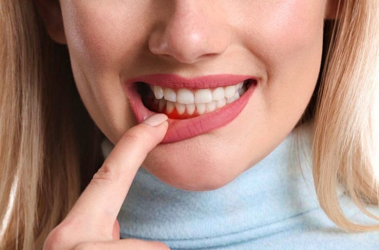 التهاب اللثة.. الأعراض والأسباب وطرق العلاج