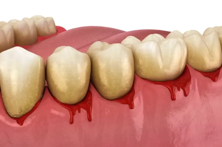 6 أسباب هامة تؤدي إلى حدوث نزيف الأسنان