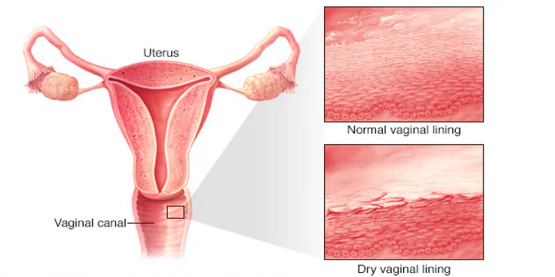 ما هي أسباب حدوث جفاف المهبل عند النساء؟