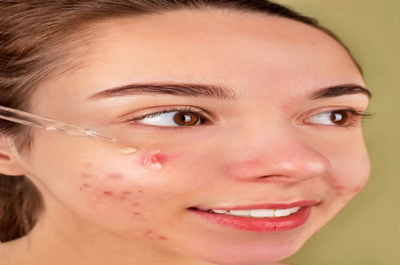 هل يمكن للبشرة الدهنية صاحبة حب الشباب استخدام فيتامين C؟