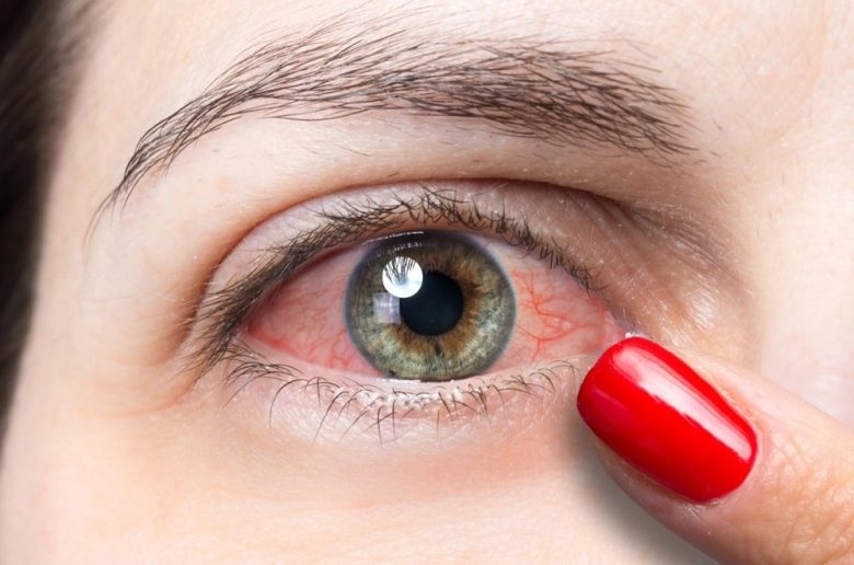 احمرار العين في جزء واحد ولكن بدون ألم