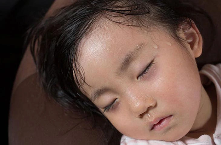 التعرق الزائد لدى الأطفال