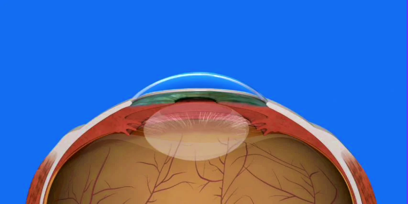 الغيوم الزجاجية وإعتام عدسة العين والعلاقة بينهم