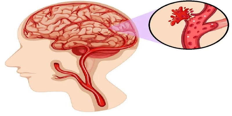 النزيف الدماغي الأولي