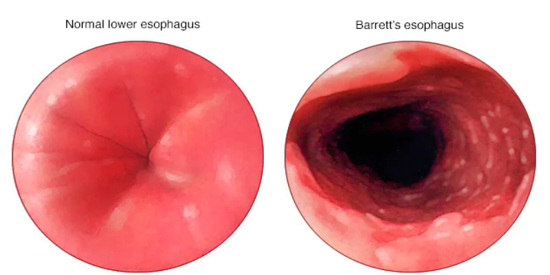 الإصابة بحالة المريء باريت