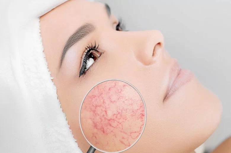 البشرة الرقيقة التي تحتوي على أوعية دموية